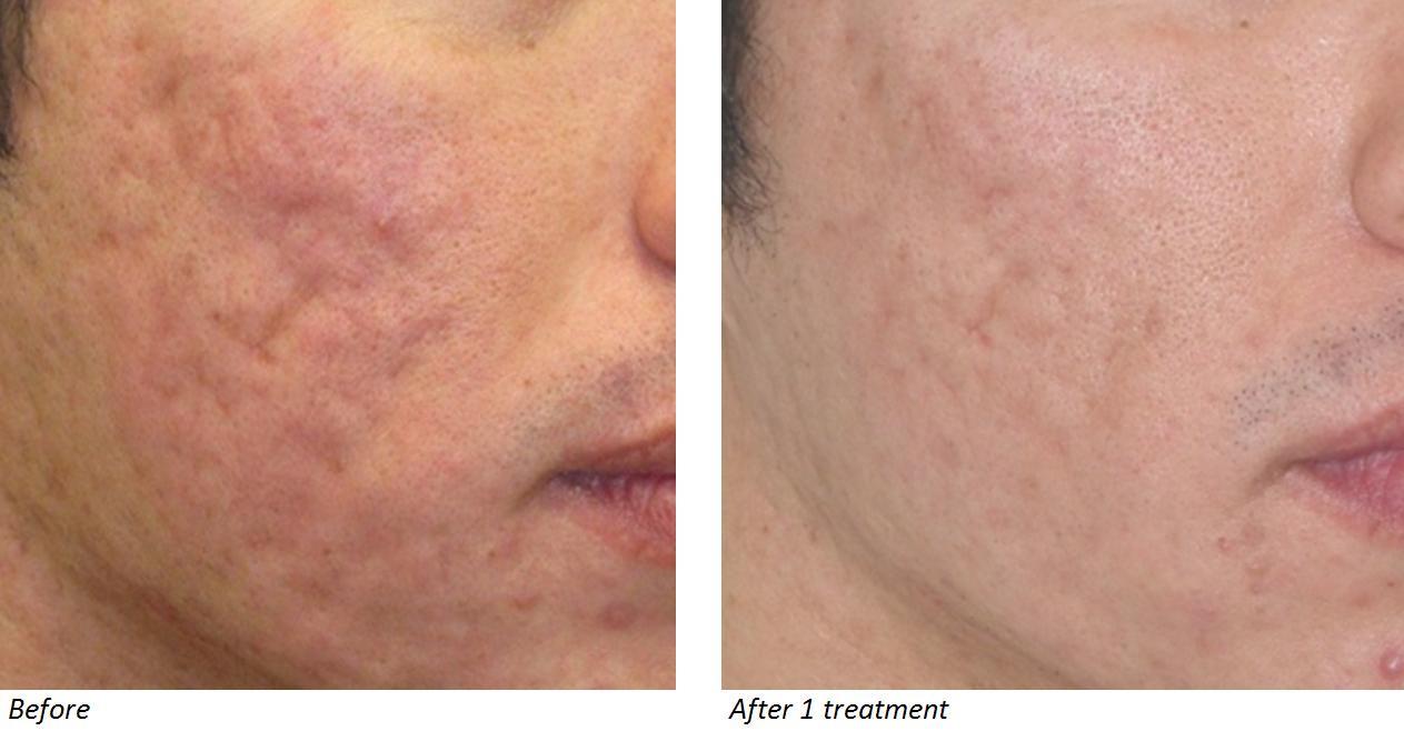 Cicatrici da acne trattate con laser CO2