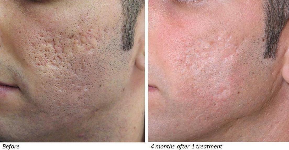 Cicatrici da acne prima e dopo il trattamento con laser co2