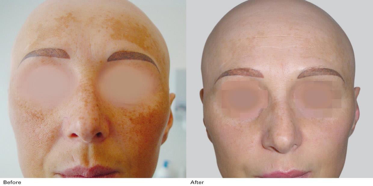 Caso prima e dopo di rimozione del melasma con laser co2