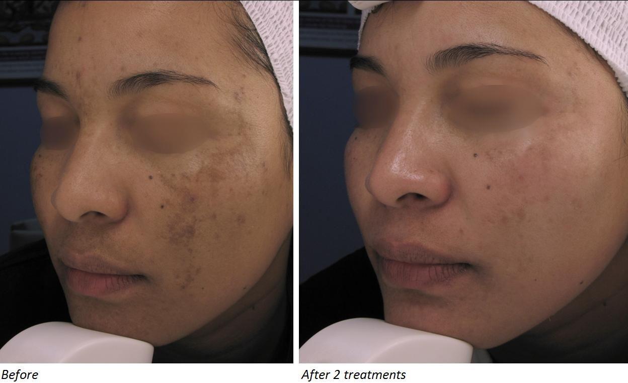 Prima e dopo di rimozione melasma con laser co2