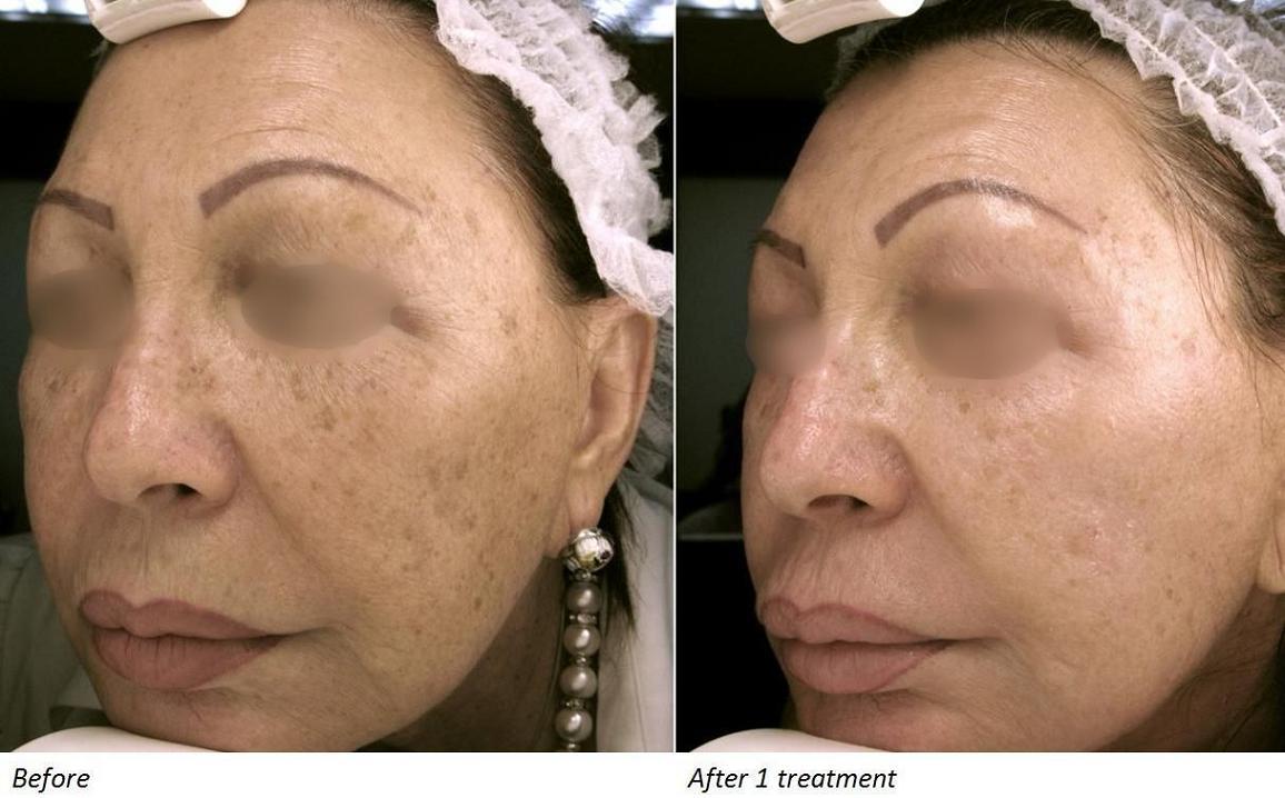 Caso di rimozione melasma con trattamento laser co2, prima e dopo