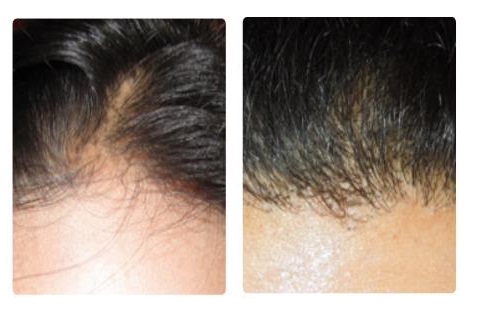 Rinfoltimento capelli con laser tricologico a CO2 e PRP